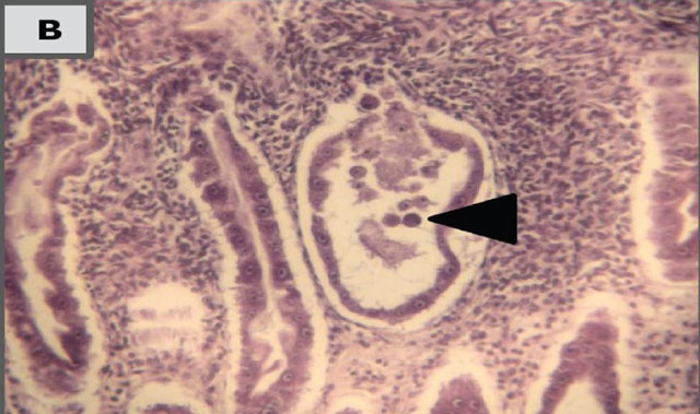 Tế bào biểu mô ống lượng gan tụy bị bong tróc và kết đặc do độc tố của vi khuẩn V. parahaemolyticus  